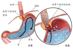 胃食管反流病怎么养？这些日常生活习惯很重要