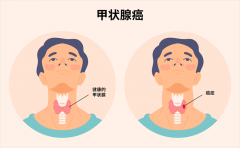 当甲状腺癌遇上靶向治疗，安罗替尼精准突破“